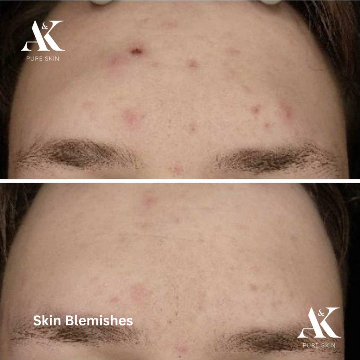 AK Pure Skin - Brightening Exfoliating Cleanser | Nettoyant exfoliant